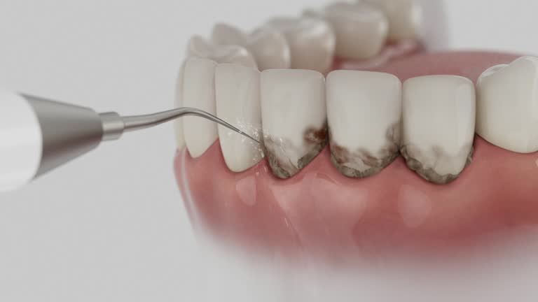 Reliable Tooth Extraction contractor in Kettering, OH by Smile Center Dentistry
